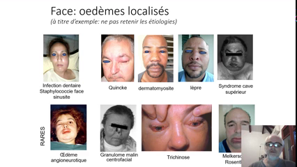 UAPod - Oedemes 3